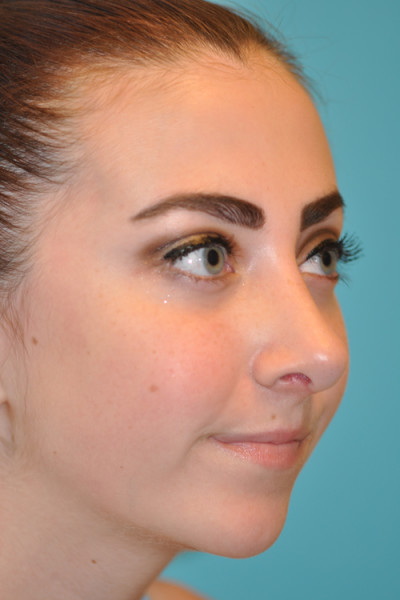 Rhinoplasty (Nose Job) Before and After Photos Case 4914 After Photo Rhinoplasty (Nose Job) Before and After Photos
