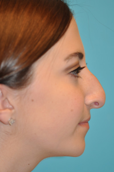 Rhinoplasty (Nose Job) Before and After Photos Case 4914 Before Photo Rhinoplasty (Nose Job) Before and After Photos