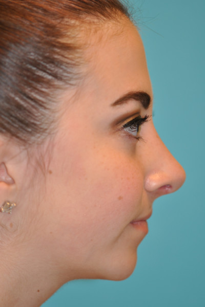 Rhinoplasty (Nose Job) Before and After Photos Case 4914 After Photo Rhinoplasty (Nose Job) Before and After Photos