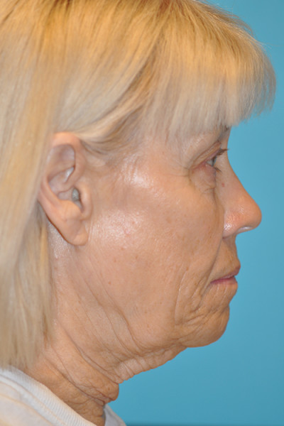 Rhytidectomy (Facelift) Before and After Photos