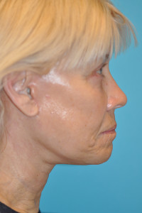 Facelift and Necklift Before and After Photos