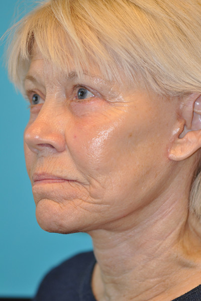 Rhytidectomy (Facelift) Before and After Photos