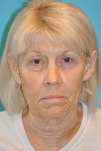 Facelift and Necklift Before and After Photos