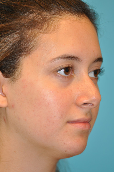 Rhinoplasty (Nose Job) Before and After Photos