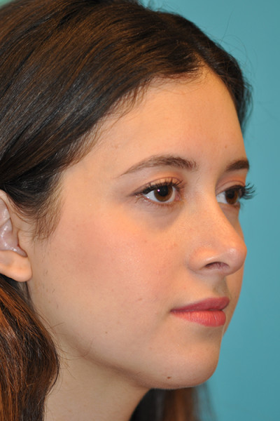 Rhinoplasty (Nose Job) Before and After Photos Case 4933 After Photo Rhinoplasty (Nose Job) Before and After Photos