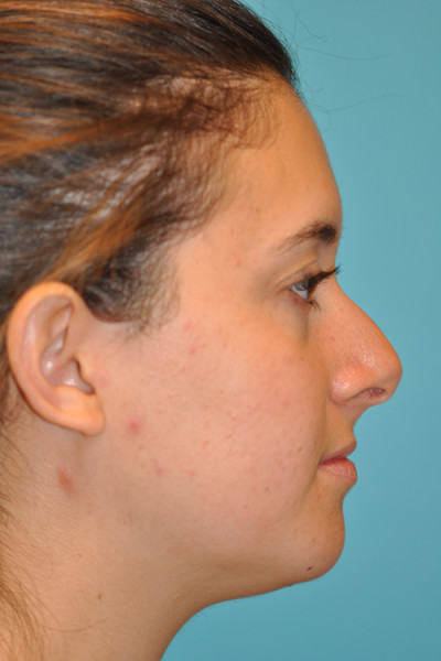 Rhinoplasty (Nose Job) Before and After Photos