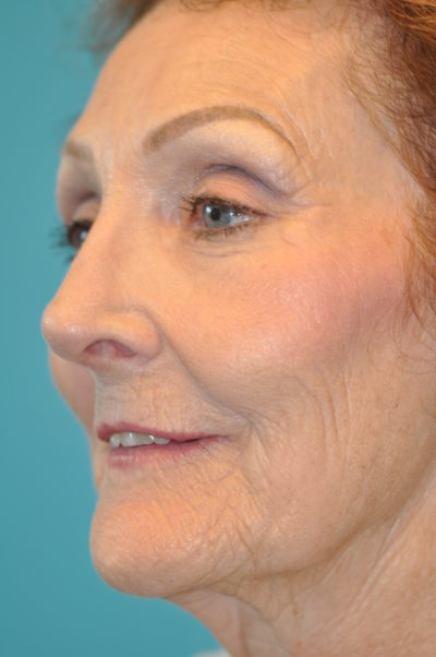 Rhinoplasty (Nose Job) Before and After Photos Case 4935 After Photo Rhinoplasty (Nose Job) Before and After Photos