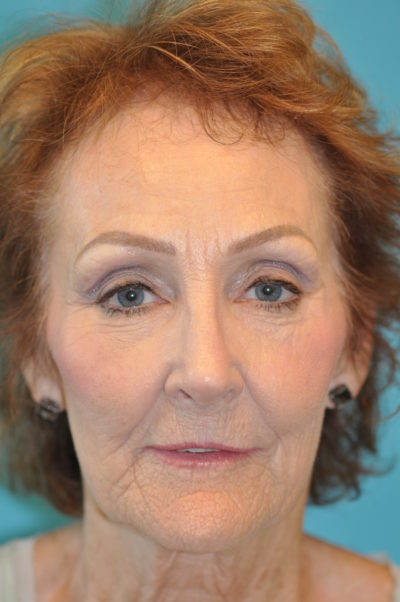 Rhinoplasty (Nose Job) Before and After Photos Case 4935 After Photo Rhinoplasty (Nose Job) Before and After Photos