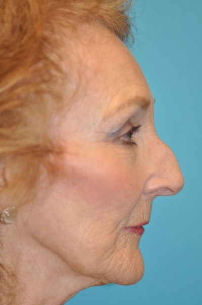 Rhinoplasty (Nose Job) Before and After Photos Case 4935 Before Photo Rhinoplasty (Nose Job) Before and After Photos