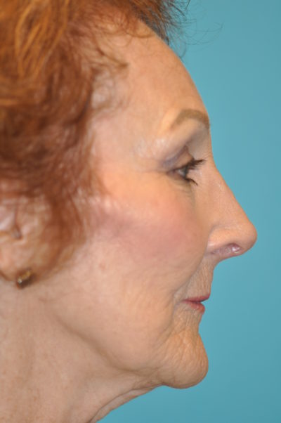 Rhinoplasty (Nose Job) Before and After Photos Case 4935 After Photo Rhinoplasty (Nose Job) Before and After Photos