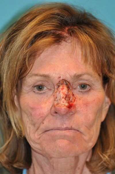 Skin Cancer Reconstruction Before and After Photos