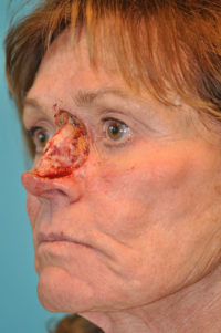 Skin Cancer Reconstruction Before and After Photos