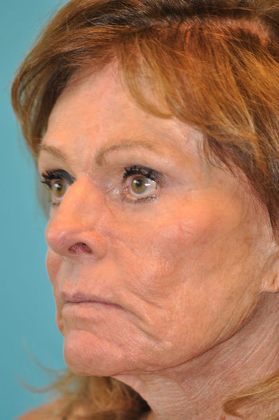 Skin Cancer Reconstruction Before and After Photos