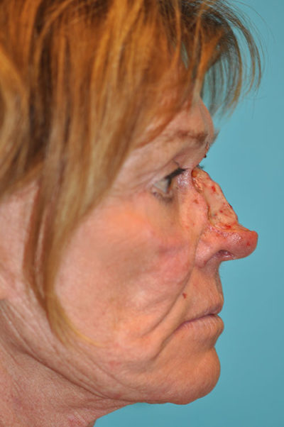 Skin Cancer Reconstruction Before and After Photos