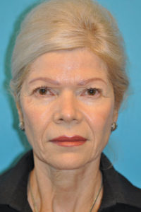 Facelift and Necklift Before and After Photos