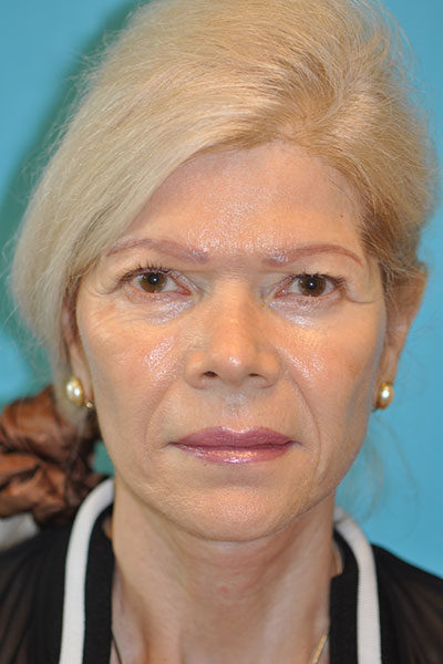 Rhytidectomy (Facelift) Before and After Photos