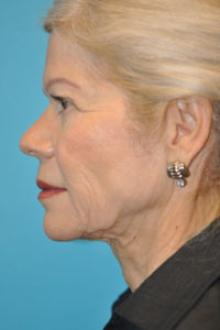 Facelift and Necklift Before and After Photos