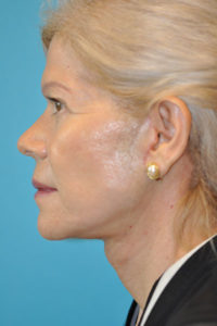 Facelift and Necklift Before and After Photos