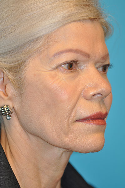 Rhytidectomy (Facelift) Before and After Photos