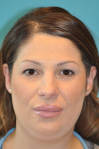 Rhinoplasty (Nose Job) Before and After Photos