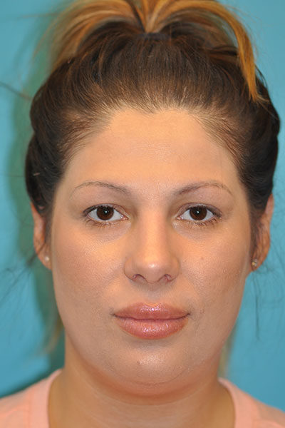 Rhinoplasty (Nose Job) Before and After Photos Case 5112 After Photo Rhinoplasty (Nose Job) Before and After Photos