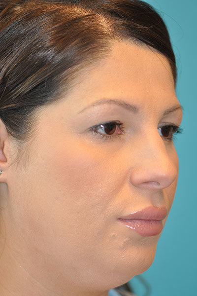 Rhinoplasty (Nose Job) Before and After Photos Case 5112 Before Photo Rhinoplasty (Nose Job) Before and After Photos