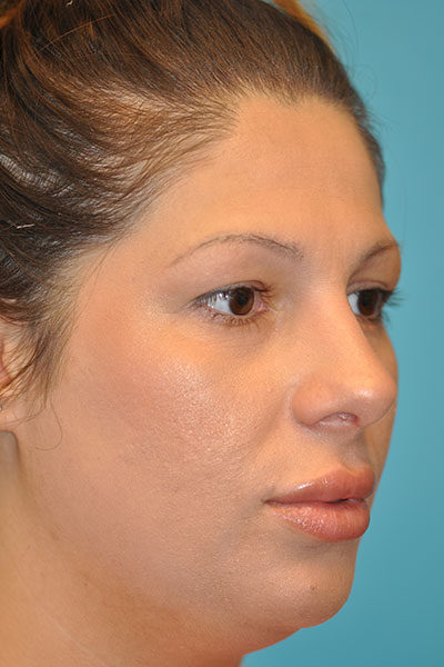 Rhinoplasty (Nose Job) Before and After Photos Case 5112 After Photo Rhinoplasty (Nose Job) Before and After Photos