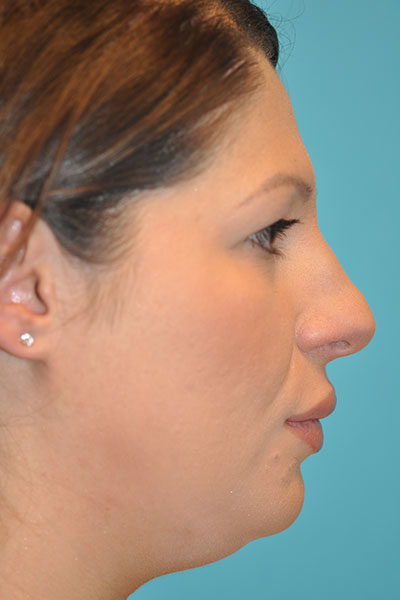 Rhinoplasty (Nose Job) Before and After Photos Case 5112 Before Photo Rhinoplasty (Nose Job) Before and After Photos