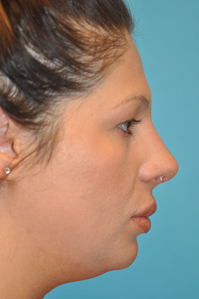 Rhinoplasty (Nose Job) Before and After Photos Case 5112 After Photo Rhinoplasty (Nose Job) Before and After Photos