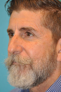 Rhinoplasty (Nose Job) Before and After Photos