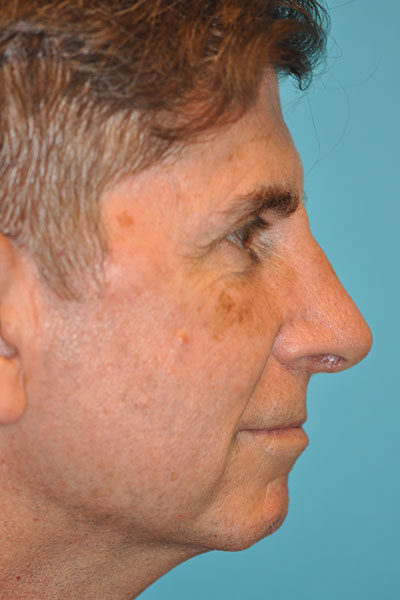 Rhinoplasty (Nose Job) Before and After Photos Case 5104 After Photo Rhinoplasty (Nose Job) Before and After Photos