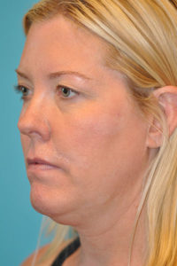 Upper Blepharoplasty (Eyelid) Before and After Photos