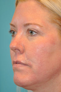 Upper Blepharoplasty (Eyelid) Before and After Photos