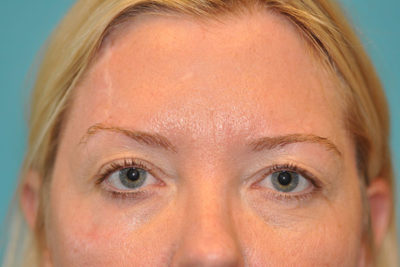 Upper Blepharoplasty (Eyelid) Before and After Photos