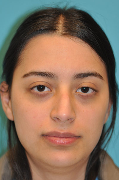 Rhinoplasty (Nose Job) Before and After Photos Case 5145 Before Photo Rhinoplasty (Nose Job) Before and After Photos