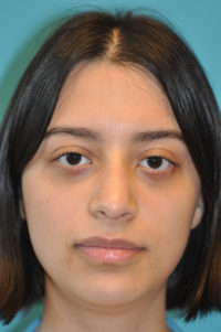 Rhinoplasty (Nose Job) Before and After Photos