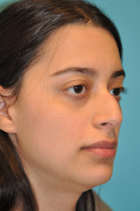Rhinoplasty (Nose Job) Before and After Photos