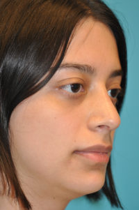 Rhinoplasty (Nose Job) Before and After Photos