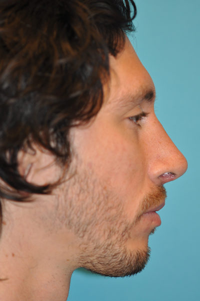 Rhinoplasty (Nose Job) Before and After Photos