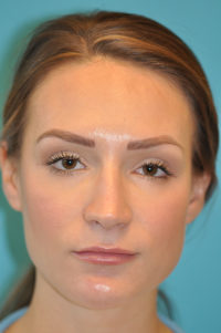 Rhinoplasty (Nose Job) Before and After Photos