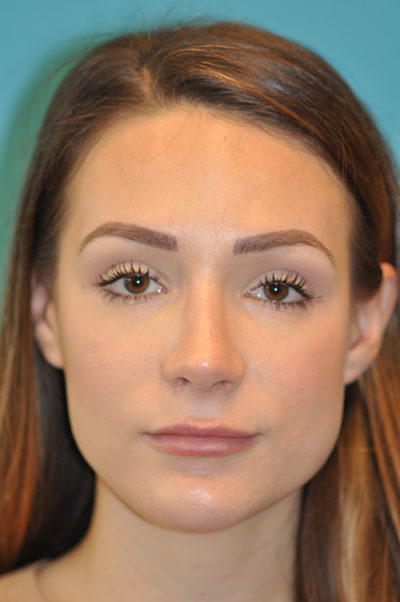 Rhinoplasty (Nose Job)