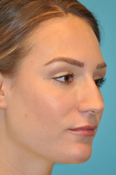 Rhinoplasty (Nose Job) Before and After Photos