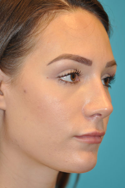 Rhinoplasty (Nose Job) Before and After Photos