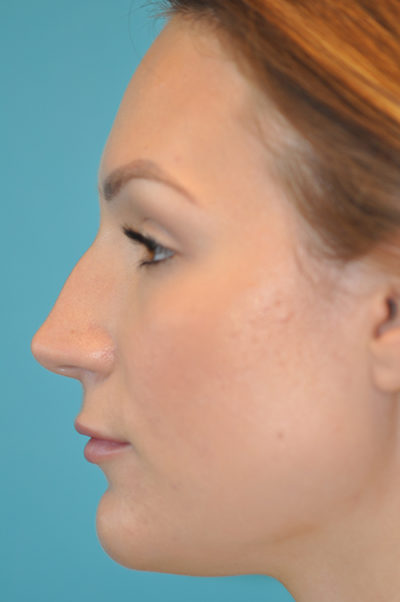 Rhinoplasty (Nose Job) Before and After Photos