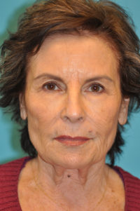 Rhytidectomy (Facelift) Before and After Photos