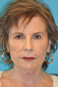 Facelift and Necklift Before and After Photos