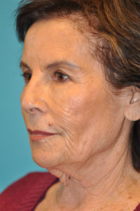 Facelift and Necklift Before and After Photos
