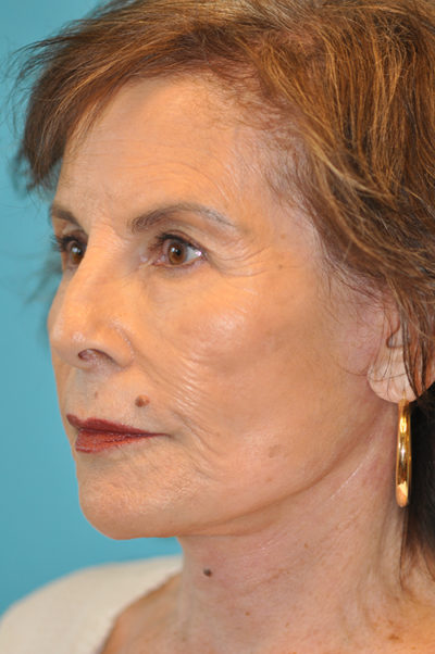 Rhytidectomy (Facelift) Before and After Photos