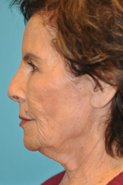 Rhytidectomy (Facelift) Before and After Photos