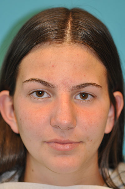 Rhinoplasty (Nose Job) Before and After Photos Case 5290 Before Photo Rhinoplasty (Nose Job) Before and After Photos